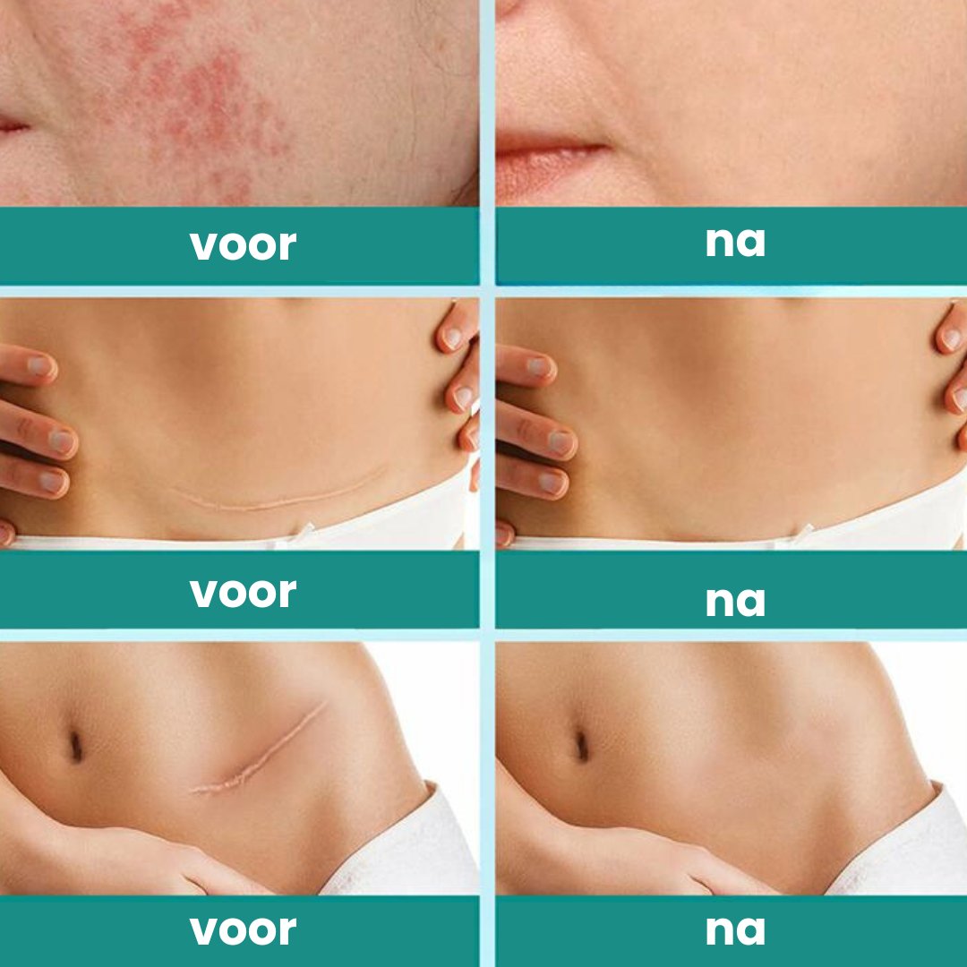 ClearMark™ Litteken verwijderaar