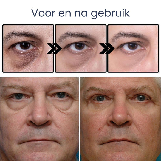 EastMoon™ Lifting Ooggel