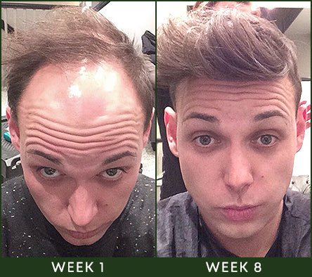 HairRecover™ Haar Regeneratie Spray