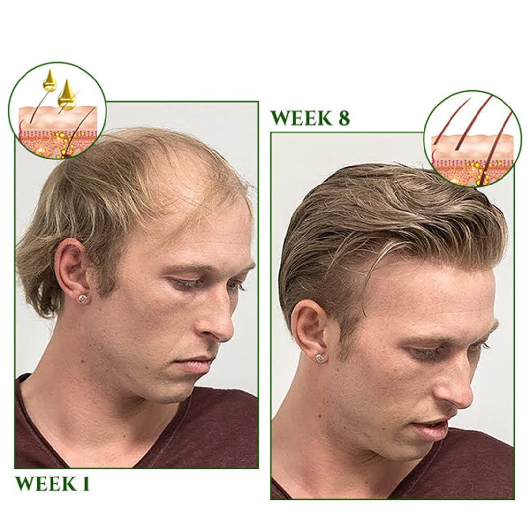 HairRecover™ Haar Regeneratie Spray