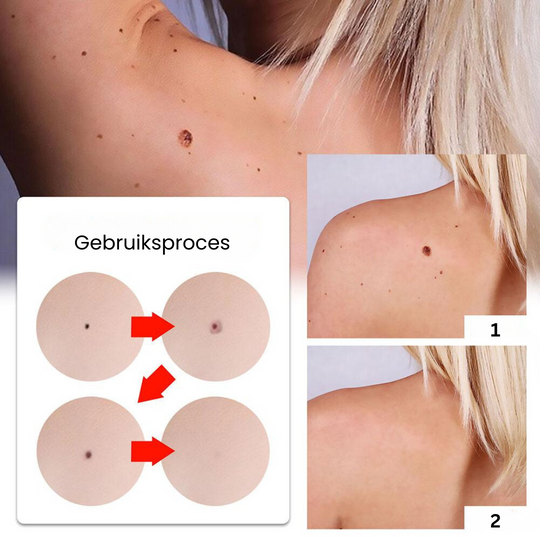 WipeOff™ Wrat en moedervlek verwijderaar