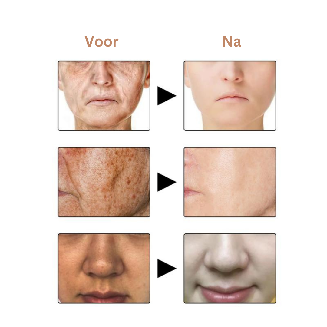 SpotVanish™ Donkere Vlek en Hyperpigmentatie Verwijderaar